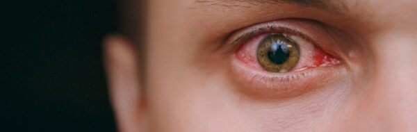 Atasi Herpes Mata: Penyebab, Gejala, Pengobatan, dan Pencegahan